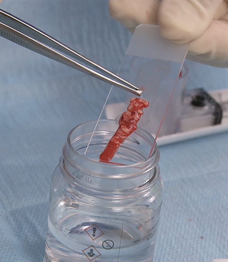 Breast tissue sample being placed on a microscope slide using forceps