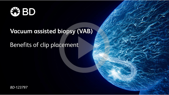 Vacuum assisted biopsy (VAB): Benefits of clip placement Video
