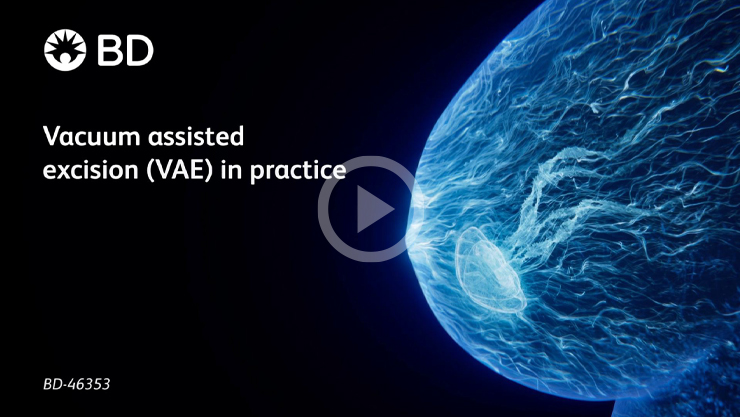 Vacuum-assisted excision (VAE) in practice EnCor Enspire™ Breast Biopsy System