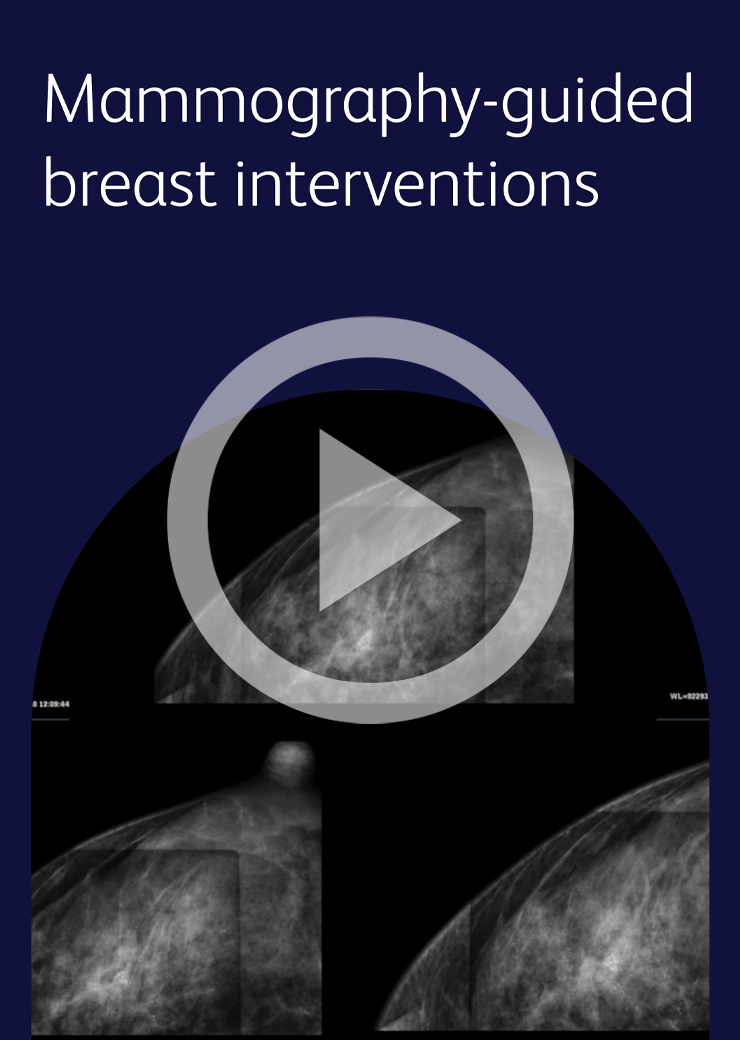 Mammography-guided breast interventions video